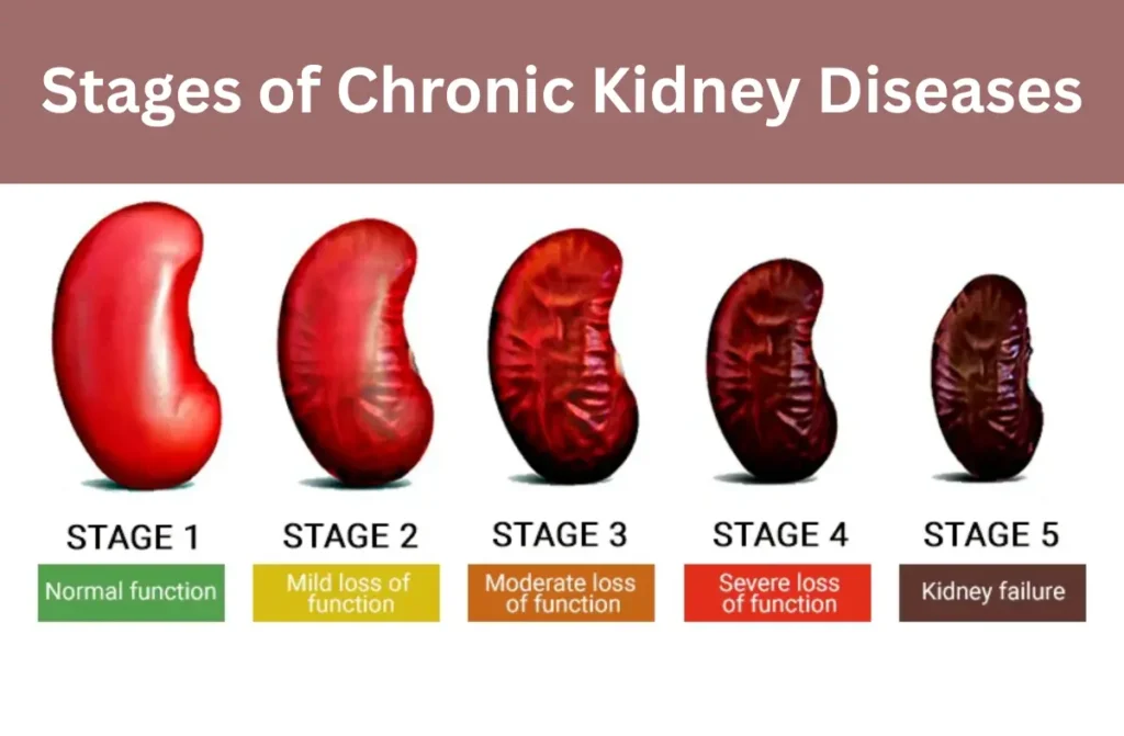 Stages of Chronic Kidney Disease